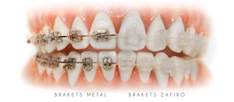 brackets de zafiro vs metalicos|ortodoncia brackets precio.